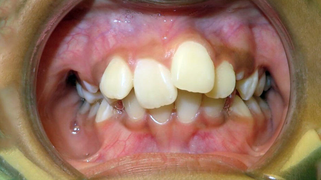 Emergency Orthodontic Care - Smilesweet Orthodontics