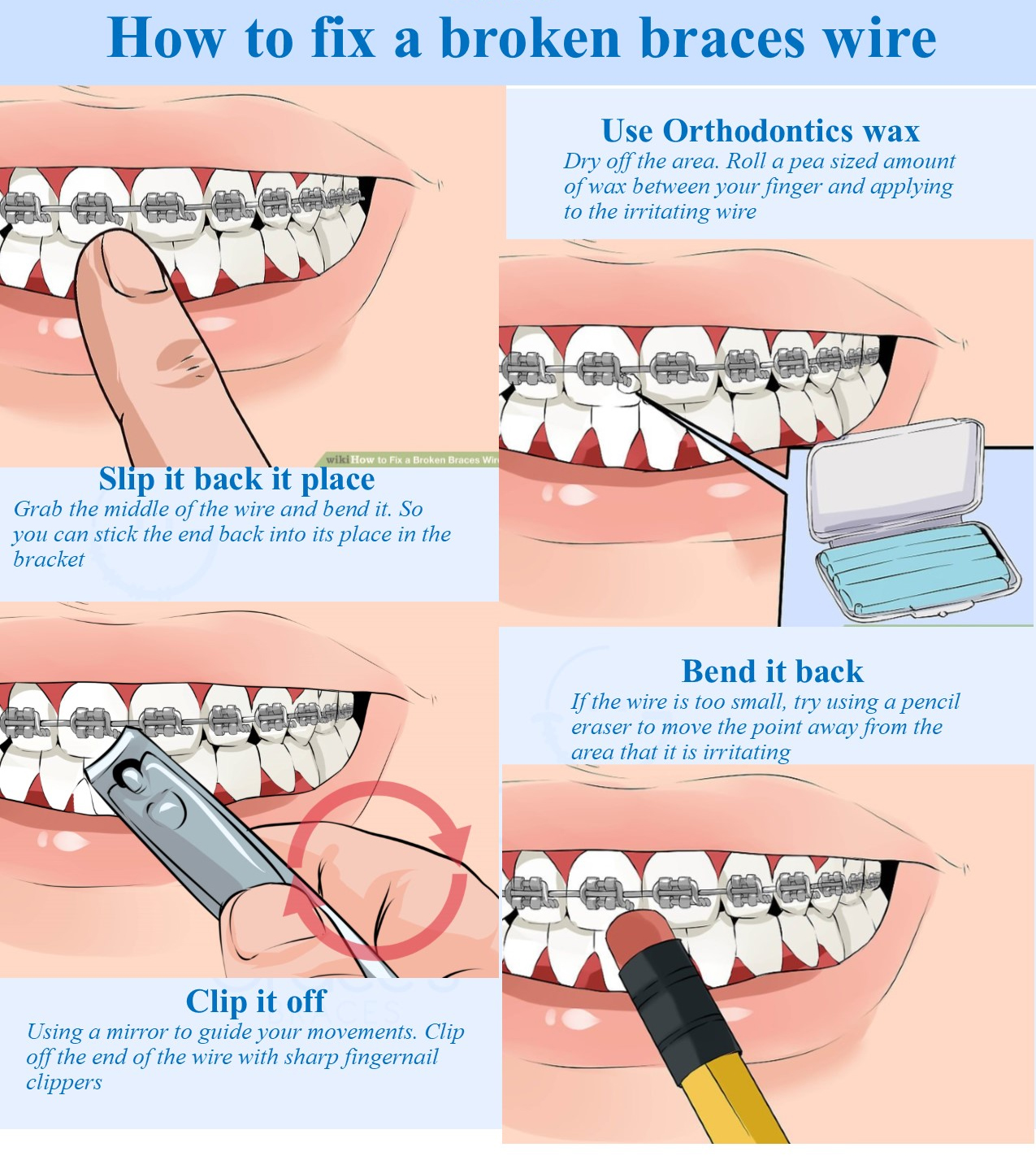 What to do if My Braces Wire Pokes Me?